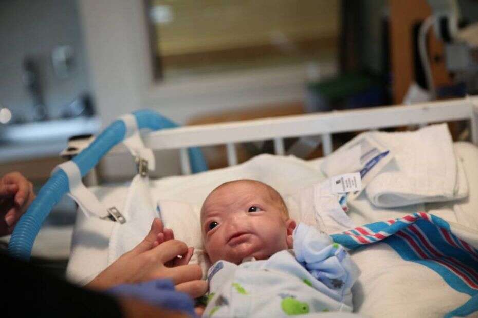 Bebê com condição rara nasce sem nariz