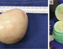 Médicos retiram “ovo cozido” gigante de dentro de bexiga de paciente