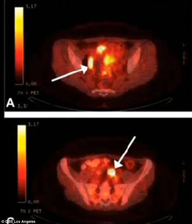 Médicos confundem tinta de tatuagens de mulher com disseminação de câncer e só descobrem erro ao retirar órgãos dela