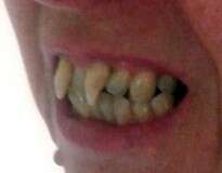 Mulher com doença grave na boca sofre com aparência após ganhar dentes de vampiro