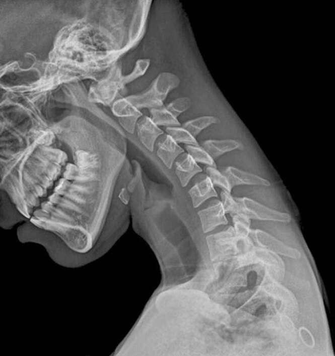 Normal flexed neck, X-ray
