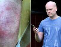 Homem desenvolve dolorosa erupção cutânea ao comprar iPhone 6 e descobre ser alérgico ao aparelho da Apple