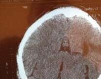 Mulher vítima de AVC encontra imagem de Jesus Cristo em raio-X de seu cérebro depois de milagrosamente sobreviver à condição