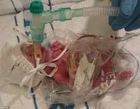 Bebê nasce prematuro e é salvo graças a saco de sanduíche usado por médicos para aquecê-lo