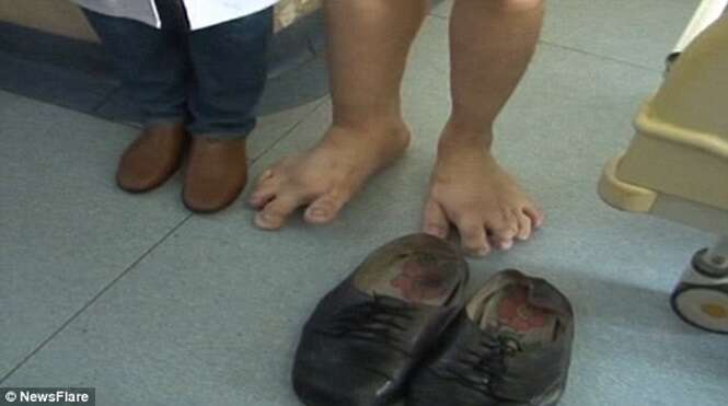 Homem com pés gigantes passa por cirurgia para conseguir andar