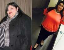 Mulher que se tornou obesa ao ponto de perder a sensibilidade no pé passa por cirurgia para remover 80% de seu estômago