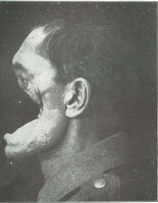 Horror of war: Facial injuries to German soldier in World War I.