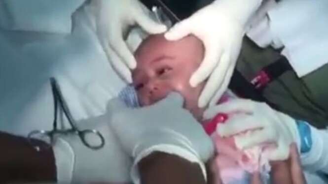 Vídeo mostra momento dramático em que médico retira relógio de pulso da garganta da criança