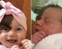 Bebê com condição rara nasce com mancha gigante no lado direito do rosto