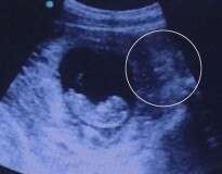 Imagem de espírito maligno surge em exame de ultrassom de grávida e causa repercussão entre internautas