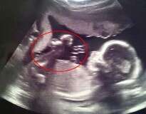 Grávida encontra imagem de anjo olhando para seu bebê durante exame de ultrassom