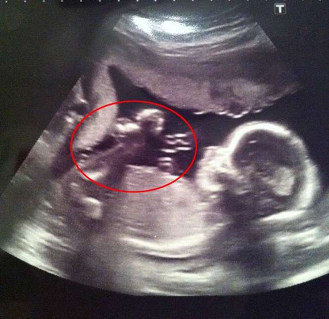 Grávida encontra imagem de anjo olhando para seu bebê durante exame de ultrassom