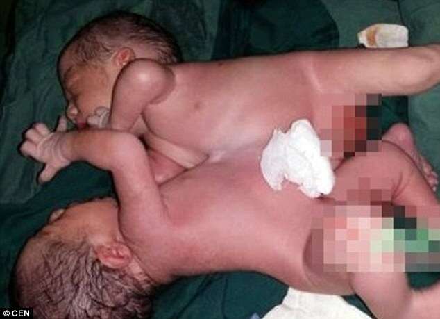 Menina de 18 anos dá à luz gêmeos siameses unidos pela barriga