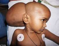 Menina de 4 anos nasce com enorme tumor na cabeça é salva graças a apelo na internet