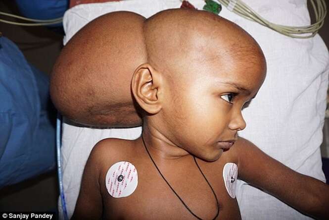 Menina nasce com enorme tumor na cabeça e apelo na internet salva sua vida