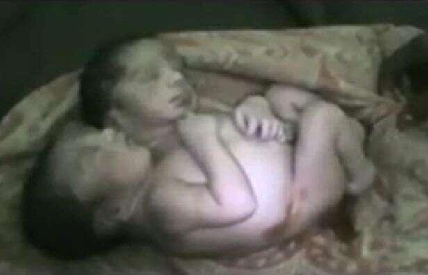 Bebê desafia médicos ao nascer com duas cabeças e sobreviver por mais de 30 horas