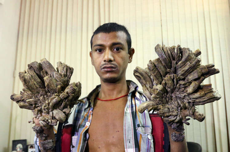 Homem sofre com condição rara que faz com que raízes de árvore cresçam em suas mãos e pés
