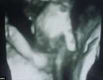Exame ultrassom mostra momento em que bebê que pode morrer no útero agarra a mão de irmã gêmea como se estivesse se despedindo