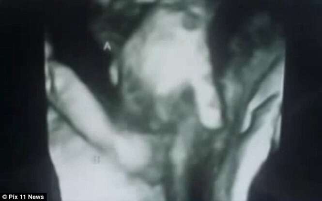 Exame ultrassom mostra momento em que bebê que pode morrer no útero agarra a mão de irmã gêmea