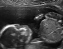 Exame de ultrassom mostra bebê se “espancando” na 20ª semana de gestação
