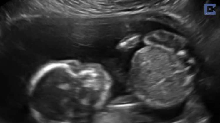 Exame ultrassom mostrou bebê se atacando