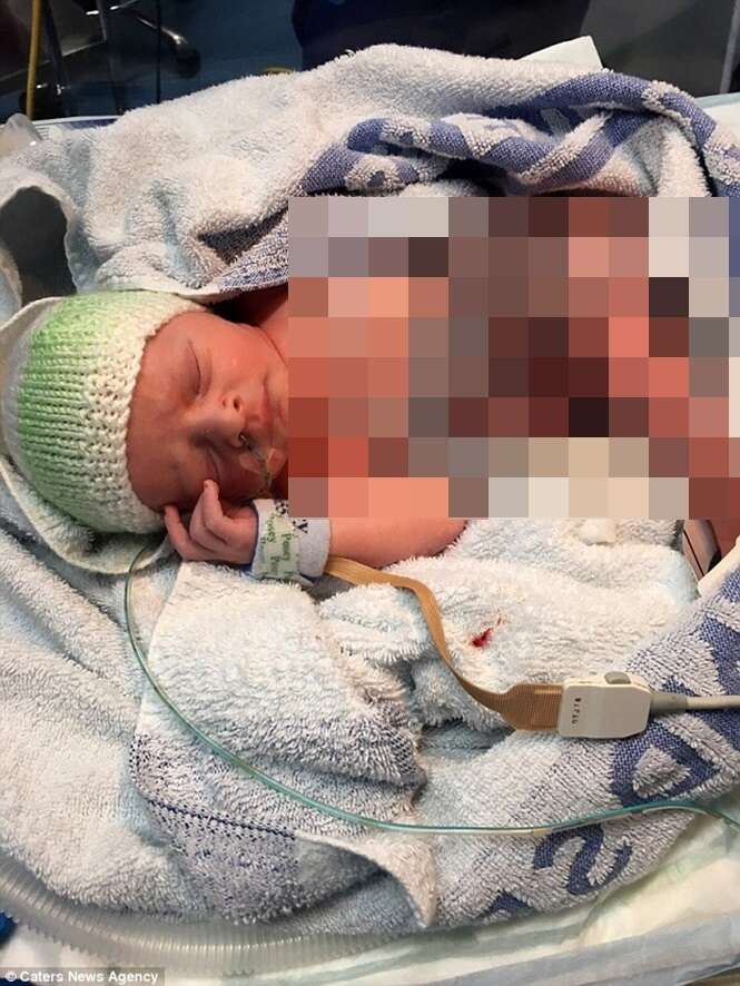 Bebê nasce com intestinos fora do corpo e escapa da morte