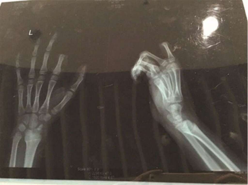 Menino corta o dedo após ser repreendido pelos pais por causa de seu vício em games de celular
