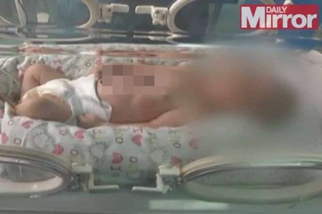 Bebê é filmado com coração batendo do lado de fora de seu corpo após nascer com má-formação