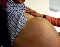 Homem com “maior tumor do mundo” fica com aparência de grávida após deixá-lo crescer por 3 anos