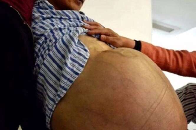 Homem com “maior tumor do mundo” fica com aparência de grávida