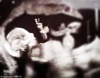 Imagem de ultrassom mostra bebê aparentemente dizendo que está vindo ao mundo em sinal de paz