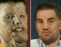 Homem que teve o rosto destruído em acidente passa por transplante facial e revela detalhes do que sofreu