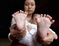 Bebê nasce com condição rara que o faz ter 15 dedos nas mãos e 16 nos pés