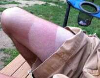 Homem com perna em três tons após tomar sol em dias diferentes viraliza na internet