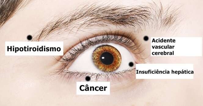 Coisas que seus olhos estão tentando lhe dizer sobre a sua saúde