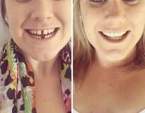 20 transformações quase inacreditáveis de pessoas que tinham dentes fora do lugar