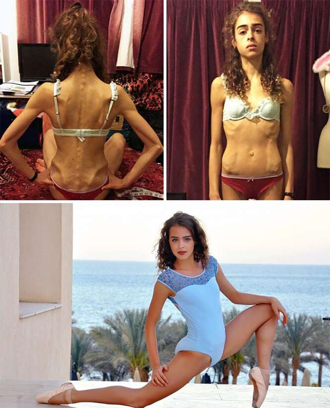 Pessoas antes e depois de vencerem a anorexia