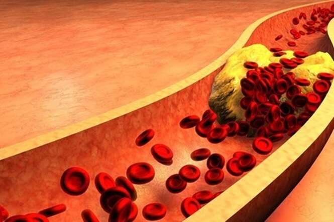 Dicas que vão te ajudar a diminuir o colesterol ruim