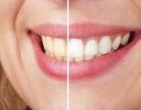 Conheça um incrível tratamento natural para clarear dentes amarelos em apenas 3 minutos