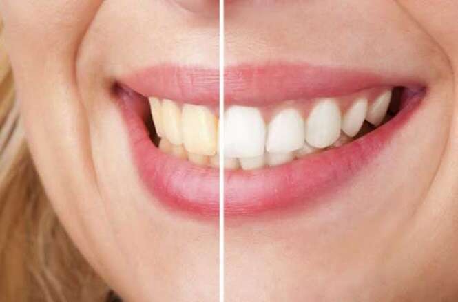 Conheça um incrível tratamento natural para clarear dentes amarelos em apenas 3 minutos