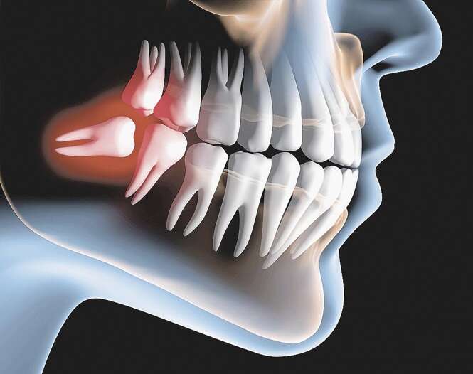 Saiba por que ter extraído os dentes do siso pode ter sido o maior erro que você já cometeu