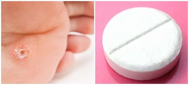 Aprenda a usar aspirina para eliminar calos