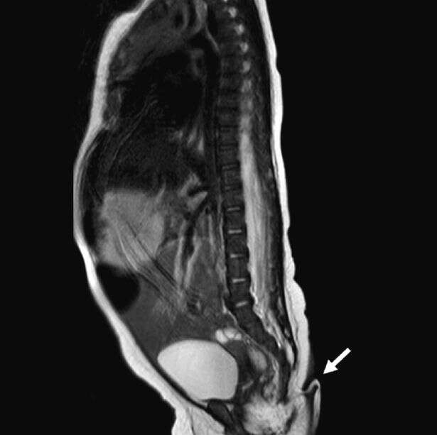 Bebê nasce com rabo de 12 centímetros em caso extremamente raro