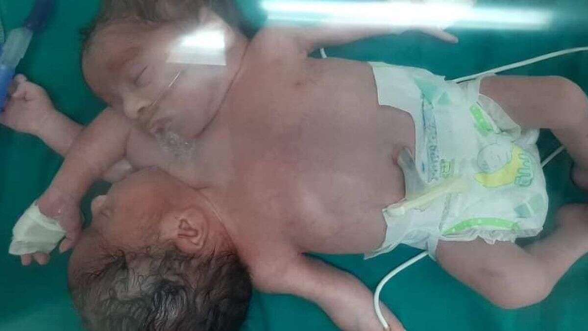 Mulher dá à luz bebês siameses de duas cabeças e quatro braços