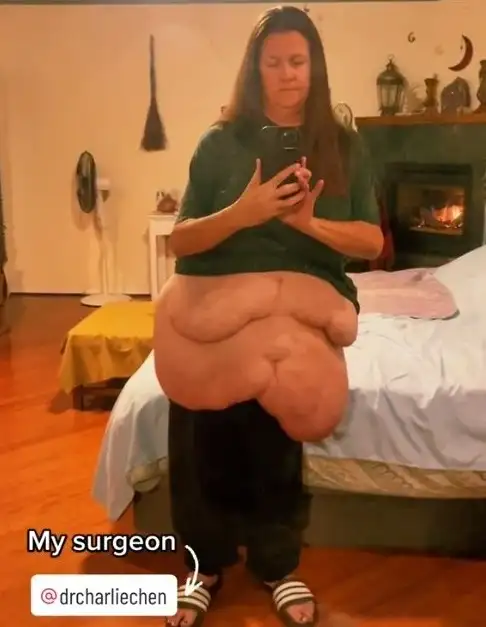 Mulher que perdeu 170 quilos sofre com excesso de pele