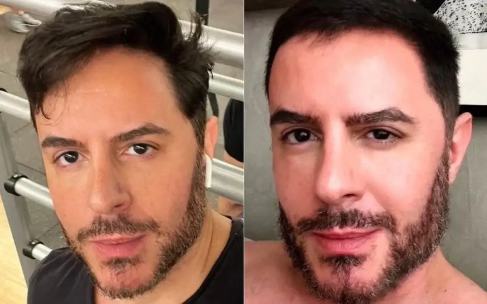 Antes e Depois de Ricardo Tozzi causa repercussão nas redes sociais