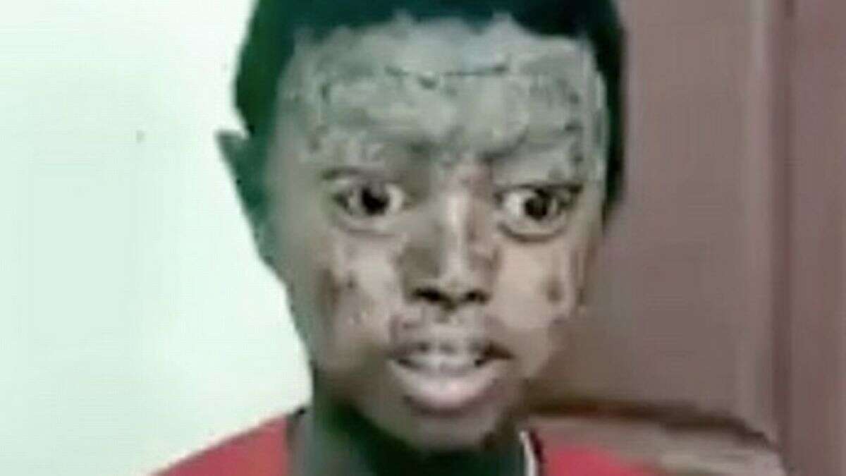Menino de 12 anos com condição rara fica com pele de cobra