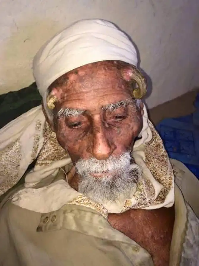 Homem mais velho do mundo que tinha chifre na cabeça morre após cirurgia mal sucedida para remover anomalia