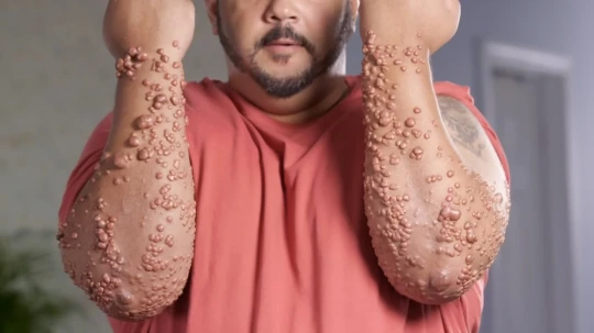 Homem vive com centenas de protuberâncias pelo corpo mas diz que não sente dor