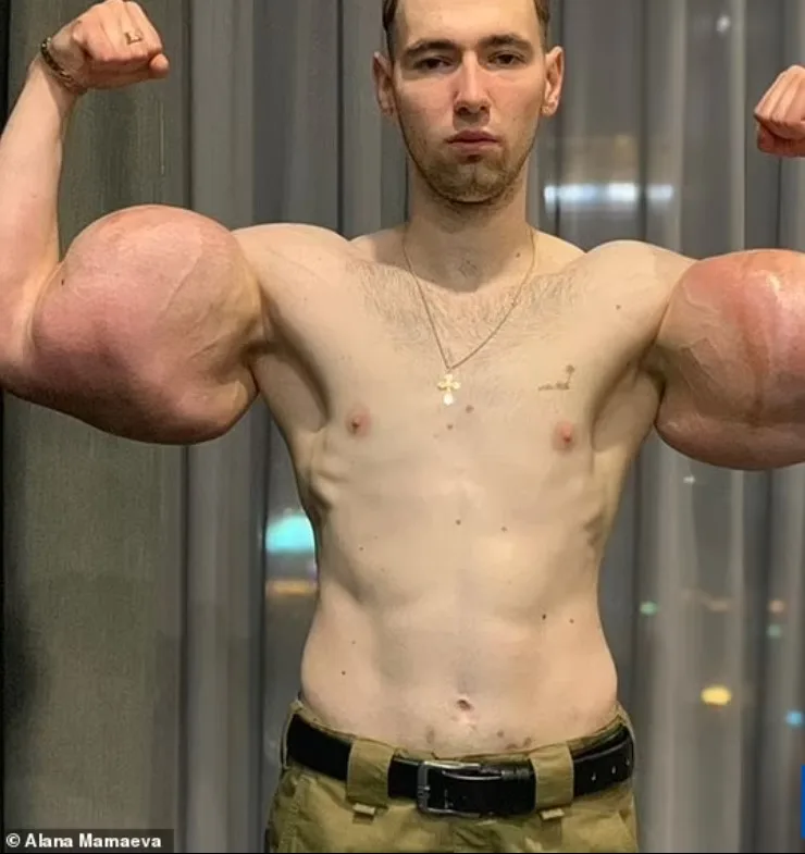 Tiktoker segue passos de famoso russo por ter bíceps gigantescos e causa polêmica